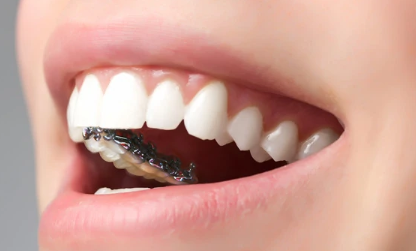 什么是隐形牙齿矫正 兰州时光整形医院杜海英专业正畸
