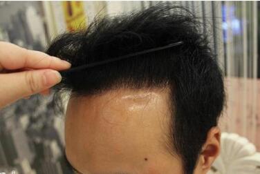 长沙碧莲盛植发整形头发种植的过程是怎么样的 价格高吗