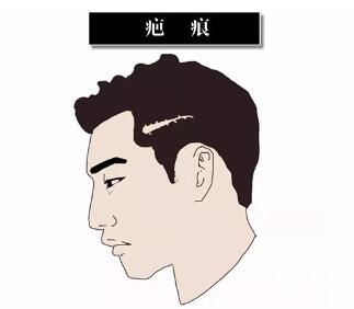 南京韩辰专业植发医院 疤痕植发受年龄限制吗