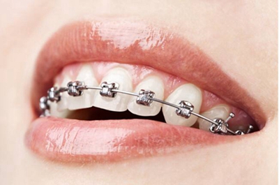 牙齿矫正方法哪种好 武汉达美口腔医院做牙齿矫正多少钱