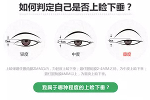 深圳中海医院整形科眼睑下垂整形手术 费用多少