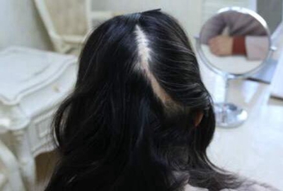 深圳丽格植发怎么样 疤痕植发费用是多少 解决斑秃烦恼
