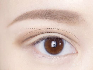 双眼皮失败情况有哪些 杭州同立医院割双眼皮修复多少钱