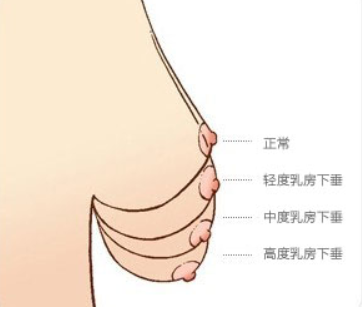 乳房下垂有救吗 武汉米兰整形医院乳房下垂矫正技术专业