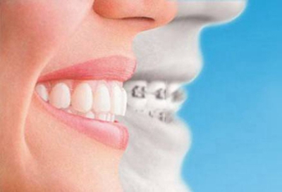 广州牙齿矫正哪里好 大概多少钱 诺尔口腔专业牙科