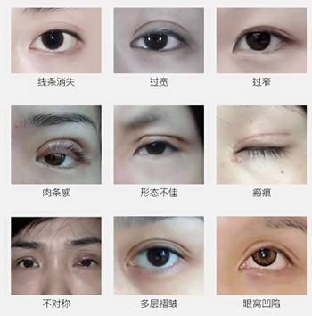 重庆天仙整形医院双眼皮修复多少钱 韩式修复技术