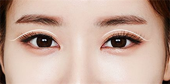 杭州碧莲盛无痕植发医院眉毛种植 提升你的整体气质