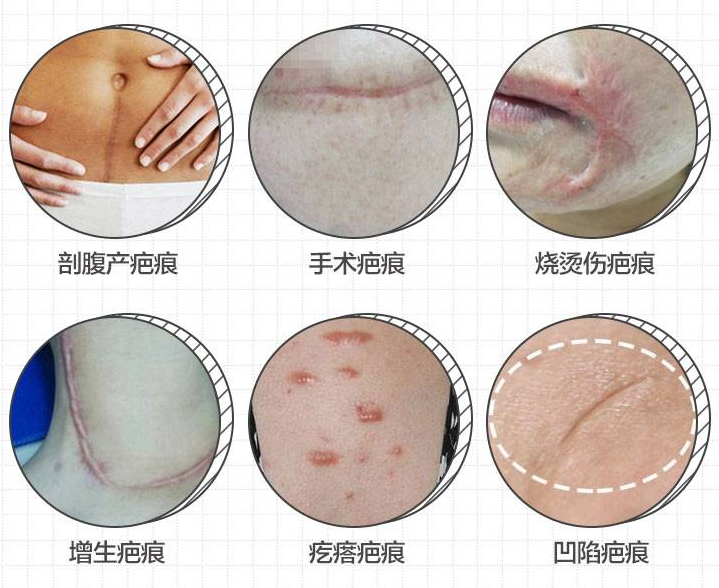 深圳唯美星整形像素激光治疗疤痕要多少钱 在线查询