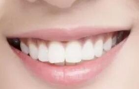 西安莲湖圣贝口腔医院种植牙 舒适美观保护你的每一份笑容