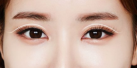 上海知音医疗整形医院双眼皮修复手术成功率高吗 多少钱