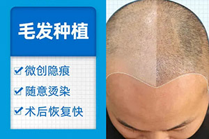 头发少怎么植发 上海大麦微针头发种植优势 多少钱