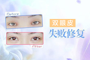 杭州华山整形医院做双眼皮修复多少钱 有没有风险吗