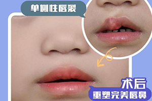 北京天成医疗整形唇裂修复手术多少钱 重塑微笑的希望