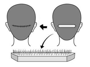 太原碧莲盛植发科头发种植原理 影响头发种植效果的因素