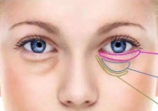 宁波壬美医疗整形美容医院激光祛眼袋优势 改善眼部纹路