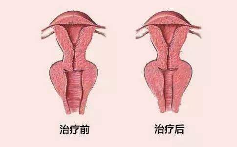 阴道紧缩术前术后效果对比图
