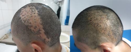 头部疤痕怎么样处理呢 疤痕植发的效果怎么样呢