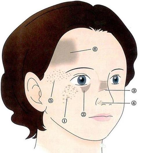 脸部肝斑分布图图片